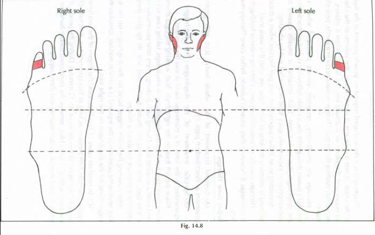 14.8 mumps viral disease img